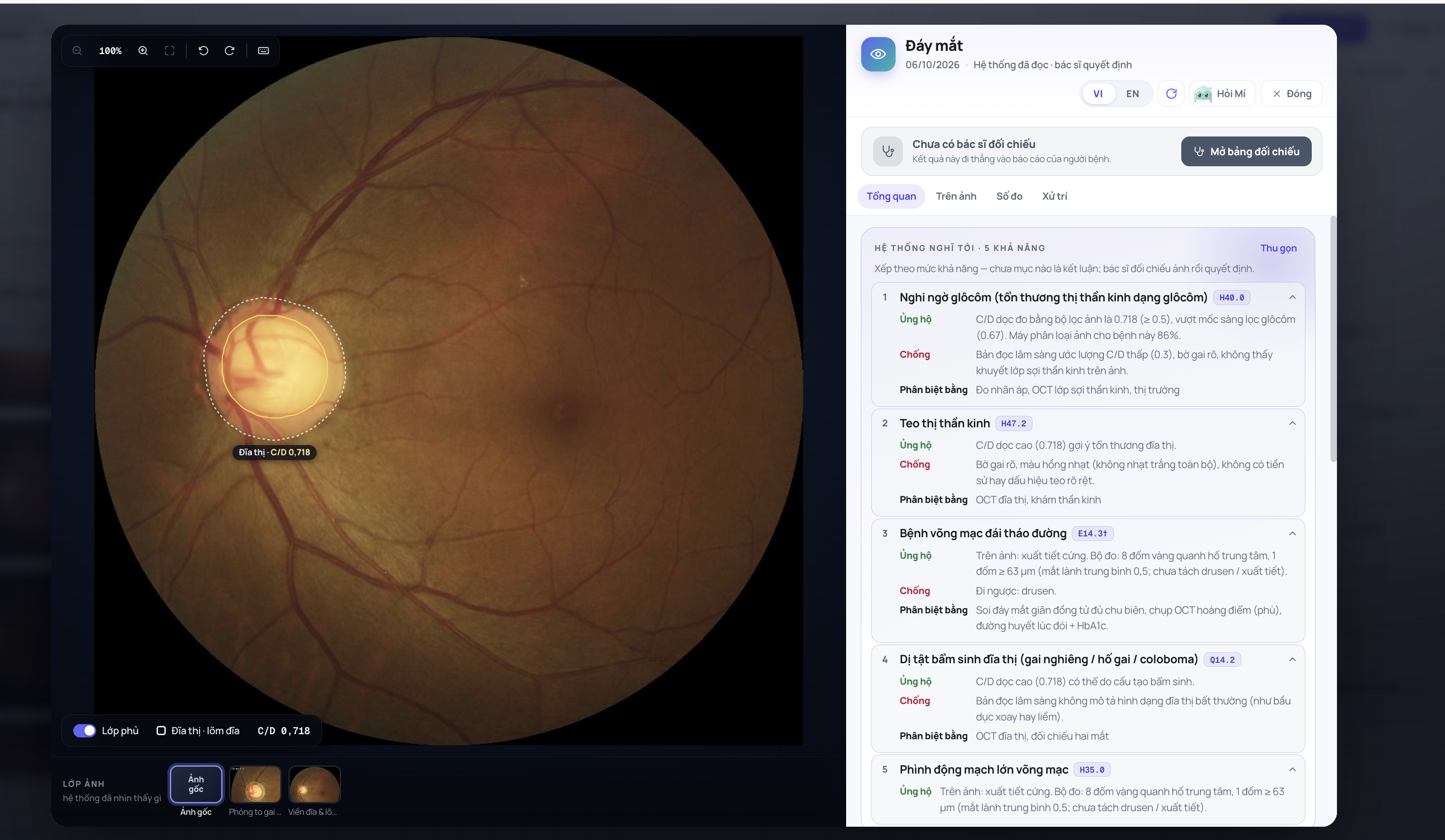 Quang Minh Suite optic disc and cup overlays with C/D measurement and clinical review panel
