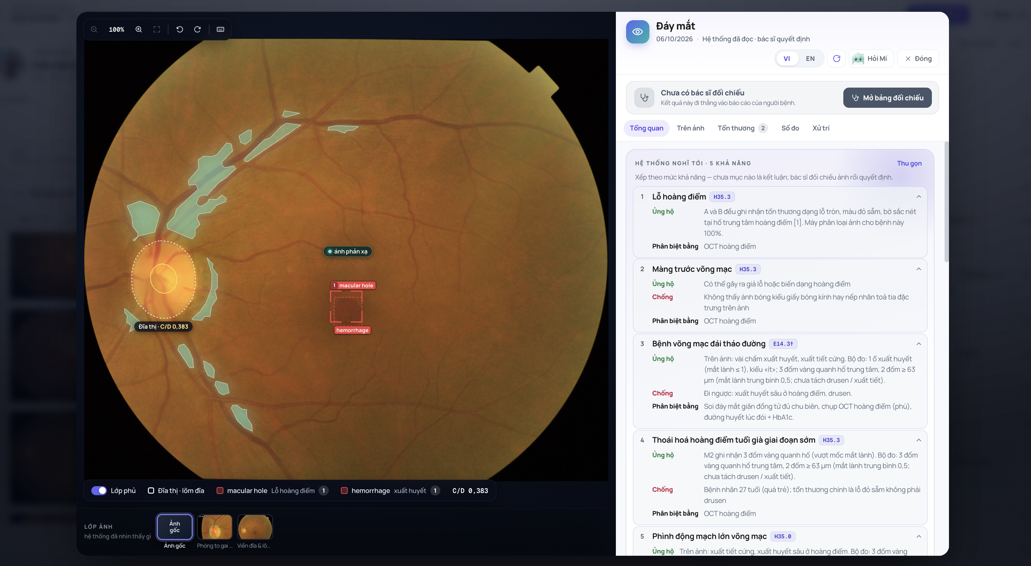 Quang Minh Suite fundus viewer with lesion annotations and clinical evidence